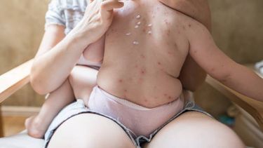 Álvaro Galiana recordó que el sarampión es una enfermedad respiratoria que se evita con vacunación