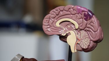 FNR incorporará tratamiento para aneurismas cerebrales