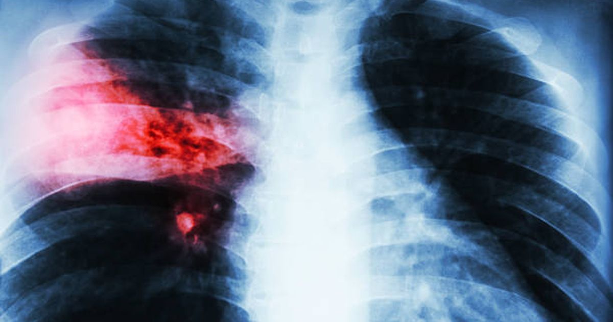 La letalidad por tuberculosis cayó a 8,5% en 2025, el registro más bajo en 23 años