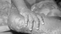 Viruela del mono en Uruguay: evoluciona favorablemente el paciente infectado