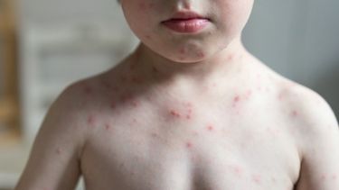 MSP estima que a finales del 2025 los casos de varicela habrán duplicado los de 2024