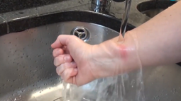 Consejos sobre cómo actuar ante quemaduras.