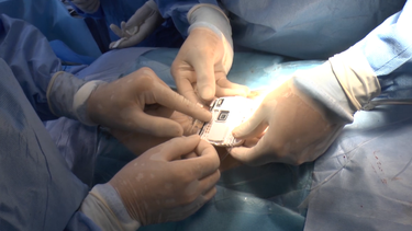 Colocaron con éxito neuroestimulador espinal en paciente del Hospital de Tacuarembó.
