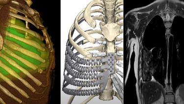 Cirujanos del Hospital Maciel realizaron una operación inédita con prótesis 3D en una paciente de 26 años