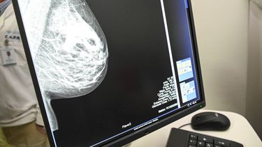 El Hospital Pereira Rossell sumó un tomógrafo de última generación.