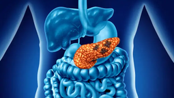 Hecho histórico: en qué consiste la triple terapia que podría cambiar el tratamiento del cáncer de páncreas