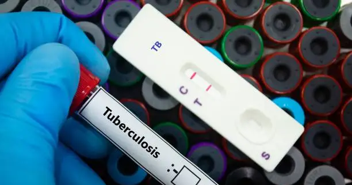 Tuberculosis en Uruguay: autoridades buscan mejorar adherencia al tratamiento para reducir contagios