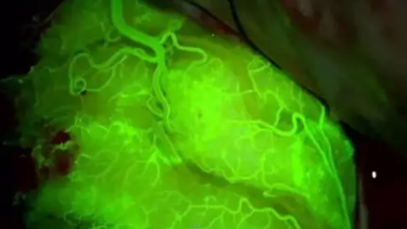 Consiguen que la quimioterapia penetre en el cerebro