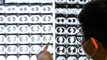 Tuberculosis en Uruguay: cuáles son las causas que explican el aumento de casos, según los expertos