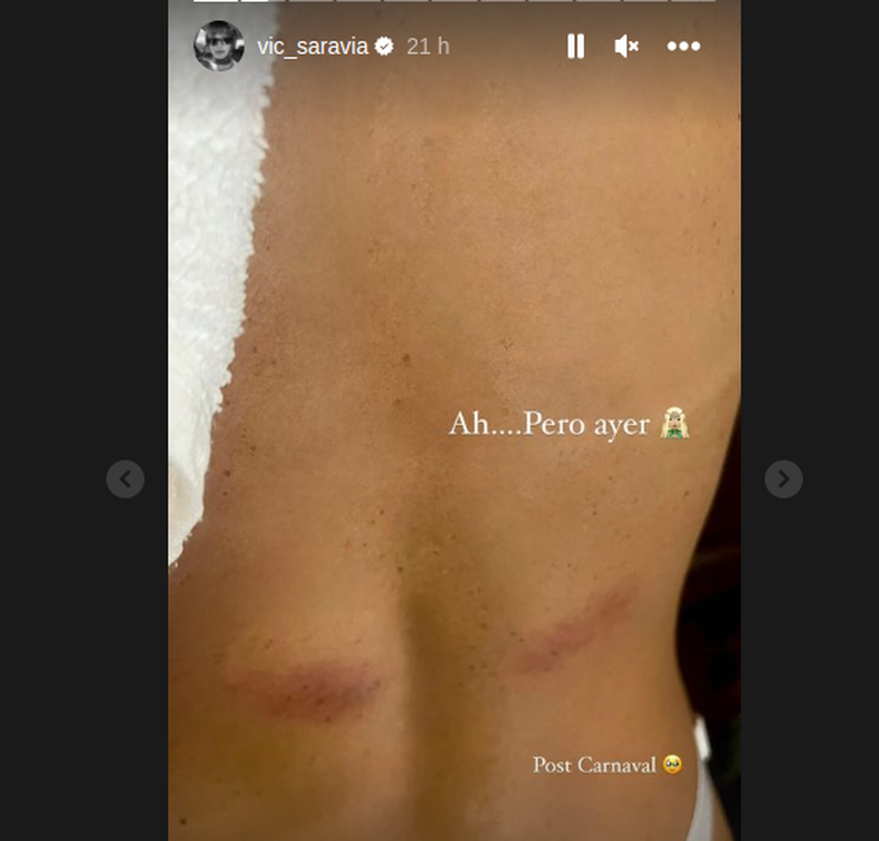 Vitto Saravia mostró las marcas que le quedaron en la espalda después del desfile de Carnaval en Melo.