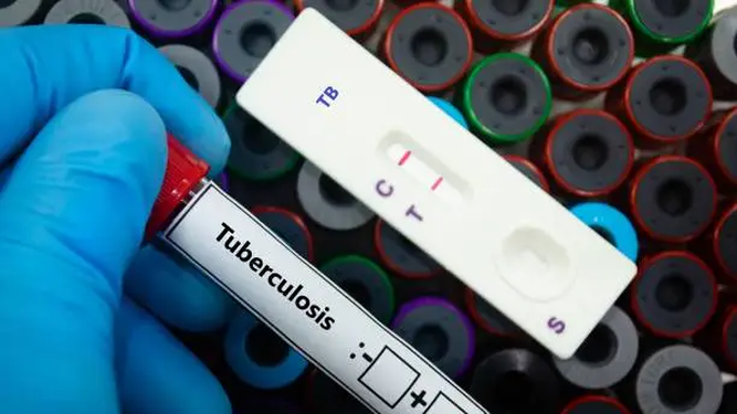 Tuberculosis en Uruguay: autoridades buscan mejorar adherencia al tratamiento para reducir contagios