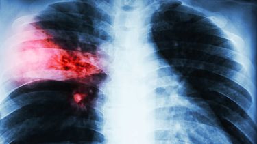 Tuberculosis en Uruguay. Tuberculosis en Uruguay.